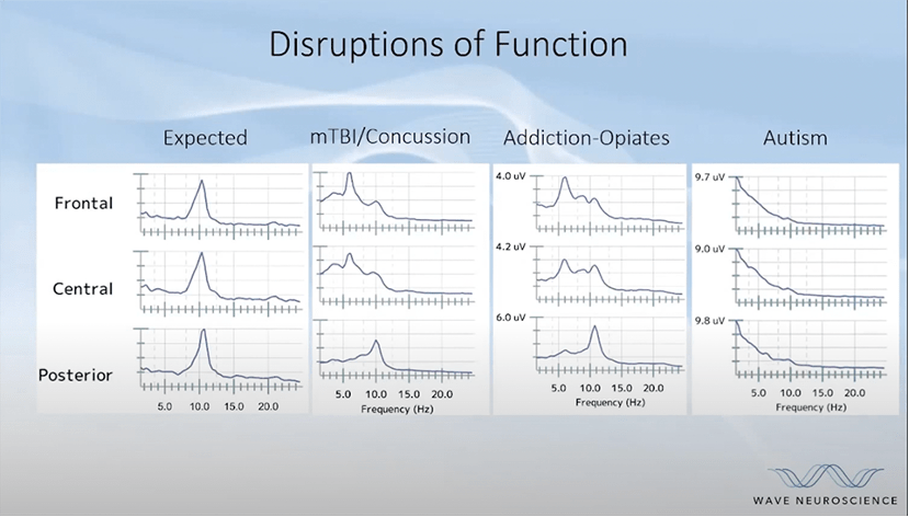 graphs showing disruptions of brainwave function before MeRT treatment