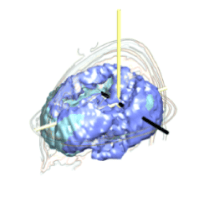 EEG image from initial analysis showing deficit