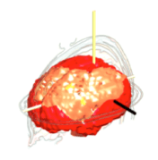EEG image from initial analysis showing excess