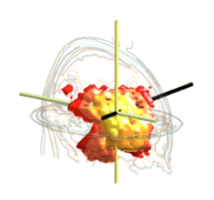 EEG image from initial analysis showing focal excess