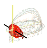 EEG image from initial analysis showing frontal lobe excess